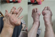 各种癌症见效才收费广西百色杨忠雅医师